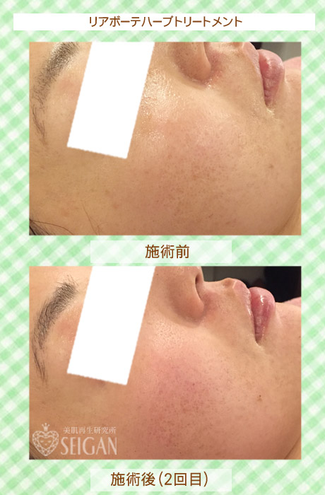初めてリアボーテハーブピーリングを受けた効果は?ビフォーアフター写真公開|東京 からだのことなら|肌・頭皮(薄毛)の悩みの改善に「ヒト幹細胞と植物幹細胞による」メディカル系フェイシャルエステケア|FCR・リアボーテハーブ・ACトリートメント・クレアスキン基礎化粧品の正規取扱いサロンです。ニキビ・ニキビ跡・クレーター・色素沈着・シワ・シミ・たるみ・毛穴のお悩みに肌質改善を