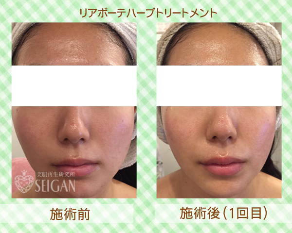 初めてリアボーテハーブピーリングを受けた効果は?ビフォーアフター写真公開|東京 からだのことなら|肌・頭皮(薄毛)の悩みの改善に「ヒト幹細胞と植物幹細胞による」メディカル系フェイシャルエステケア|FCR・リアボーテハーブ・ACトリートメント・クレアスキン基礎化粧品の正規取扱いサロンです。ニキビ・ニキビ跡・クレーター・色素沈着・シワ・シミ・たるみ・毛穴のお悩みに肌質改善を