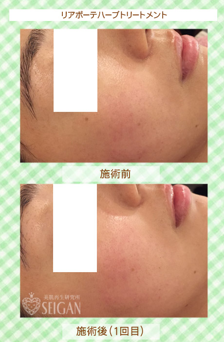 初めてリアボーテハーブピーリングを受けた効果は?ビフォーアフター写真公開|東京 からだのことなら|肌・頭皮(薄毛)の悩みの改善に「ヒト幹細胞と植物幹細胞による」メディカル系フェイシャルエステケア|FCR・リアボーテハーブ・ACトリートメント・クレアスキン基礎化粧品の正規取扱いサロンです。ニキビ・ニキビ跡・クレーター・色素沈着・シワ・シミ・たるみ・毛穴のお悩みに肌質改善を