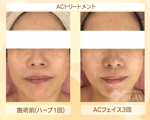 初めてACトリートメントを受けた効果は?ビフォーアフター写真公開|東京 からだのことなら|肌・頭皮(薄毛)の悩みの改善に「ヒト幹細胞と植物幹細胞による」メディカル系フェイシャルエステケア|FCR・リアボーテハーブ・ACトリートメント・クレアスキン基礎化粧品の正規取扱いサロンです。ニキビ・ニキビ跡・クレーター・色素沈着・シワ・シミ・たるみ・毛穴のお悩みに肌質改善を