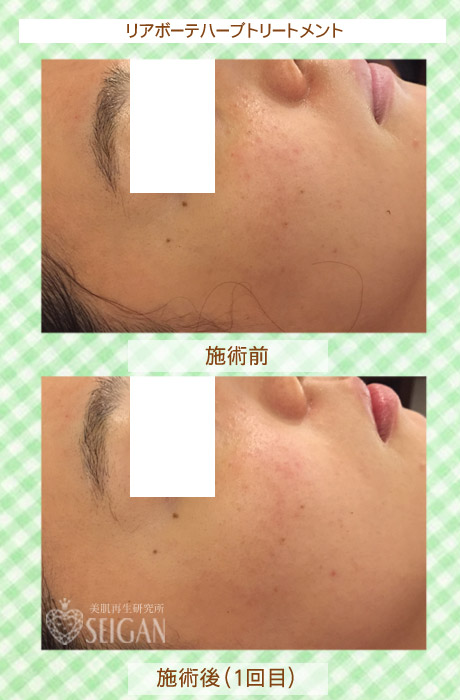 初めてリアボーテハーブピーリングを受けた効果は？ビフォーアフター写真公開｜東京 からだのことなら｜肌・頭皮（薄毛）の悩みの改善に「ヒト幹細胞と植物幹細胞による」メディカル系フェイシャルエステケア｜FCR・リアボーテハーブ・ACトリートメント・クレアスキン基礎化粧品の正規取扱いサロンです。ニキビ・ニキビ跡・クレーター・色素沈着・シワ・シミ・たるみ・毛穴のお悩みに肌質改善を