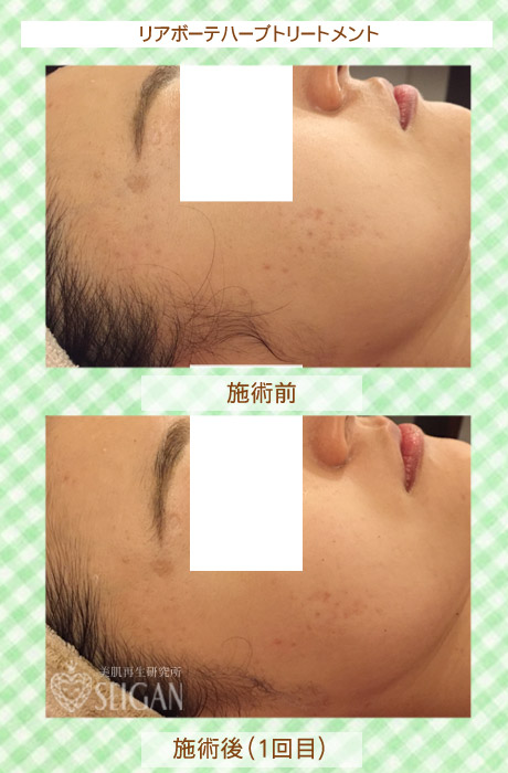 初めてリアボーテハーブピーリングを受けた効果は？ビフォーアフター写真公開｜東京 からだのことなら｜肌・頭皮（薄毛）の悩みの改善に「ヒト幹細胞と植物幹細胞による」メディカル系フェイシャルエステケア｜FCR・リアボーテハーブ・ACトリートメント・クレアスキン基礎化粧品の正規取扱いサロンです。ニキビ・ニキビ跡・クレーター・色素沈着・シワ・シミ・たるみ・毛穴のお悩みに肌質改善を