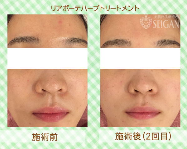 初めてリアボーテハーブピーリングを受けた効果は?ビフォーアフター写真公開|東京 からだのことなら|肌・頭皮(薄毛)の悩みの改善に「ヒト幹細胞と植物幹細胞による」メディカル系フェイシャルエステケア|FCR・リアボーテハーブ・ACトリートメント・クレアスキン基礎化粧品の正規取扱いサロンです。ニキビ・ニキビ跡・クレーター・色素沈着・シワ・シミ・たるみ・毛穴のお悩みに肌質改善を