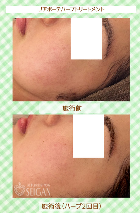 初めてリアボーテハーブピーリングを受けた効果は?ビフォーアフター写真公開|東京 からだのことなら|肌・頭皮(薄毛)の悩みの改善に「ヒト幹細胞と植物幹細胞による」メディカル系フェイシャルエステケア|FCR・リアボーテハーブ・ACトリートメント・クレアスキン基礎化粧品の正規取扱いサロンです。ニキビ・ニキビ跡・クレーター・色素沈着・シワ・シミ・たるみ・毛穴のお悩みに肌質改善を