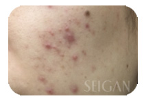 リアボーテお試し幹細胞トリートメント ｜【東京 港区 北青山】「からだのことなら」は、肌・髪・体・心の悩み改善に「丁寧に寄り添う」メディカル系ケア施術院です。肌質改善・加齢肌対策・薄毛・抜け毛をはじめ、体調不良・痛みなどでお悩みなら1度ご来院下さい。