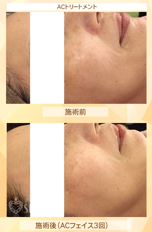 初めてリアボーテ ハーブトリートメント・ACトリートメントを受けた効果がすごい!ビフォーアフター写真一気に公開|東京 港区 外苑前駅から徒歩2分 「エステ以上、美容外科未満」のメディカル系エステなら 肌質改善のための 本格スキンケアエステサロン からだのことならへ|FCR・リアボーテハーブ・ACトリートメント・クレアスキン・グランスキン・リアムール基礎化粧品の正規取扱い店です。毛穴・ニキビ・ニキビ跡・クレーター・色素沈着・シワ・シミ・たるみのお悩みに肌質改善を