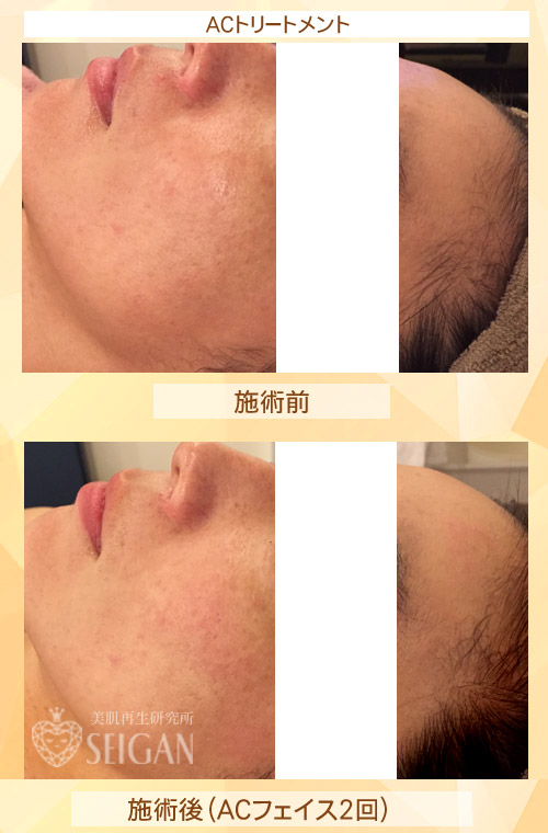 初めてリアボーテ ハーブトリートメント・ACトリートメントを受けた効果がすごい!ビフォーアフター写真一気に公開|東京 港区 外苑前駅から徒歩2分 「エステ以上、美容外科未満」のメディカル系エステなら 肌質改善のための 本格スキンケアエステサロン からだのことならへ|FCR・リアボーテハーブ・ACトリートメント・クレアスキン・グランスキン・リアムール基礎化粧品の正規取扱い店です。毛穴・ニキビ・ニキビ跡・クレーター・色素沈着・シワ・シミ・たるみのお悩みに肌質改善を