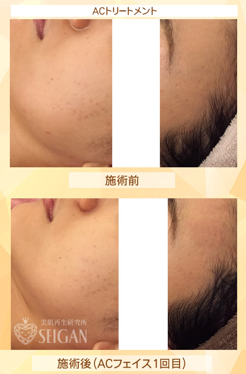 初めてリアボーテ ハーブトリートメント・ACトリートメントを受けた効果がすごい!ビフォーアフター写真一気に公開|東京 港区 外苑前駅から徒歩2分 「エステ以上、美容外科未満」のメディカル系エステなら 肌質改善のための 本格スキンケアエステサロン からだのことならへ|FCR・リアボーテハーブ・ACトリートメント・クレアスキン・グランスキン・リアムール基礎化粧品の正規取扱い店です。毛穴・ニキビ・ニキビ跡・クレーター・色素沈着・シワ・シミ・たるみのお悩みに肌質改善を