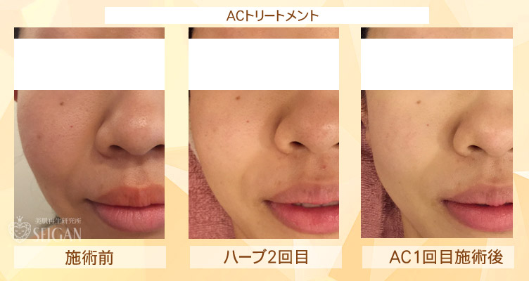 初めてリアボーテ ハーブトリートメント・ACトリートメントを受けた効果がすごい!ビフォーアフター写真一気に公開|東京 港区 外苑前駅から徒歩2分 「エステ以上、美容外科未満」のメディカル系エステなら 肌質改善のための 本格スキンケアエステサロン からだのことならへ|FCR・リアボーテハーブ・ACトリートメント・クレアスキン・グランスキン・リアムール基礎化粧品の正規取扱い店です。毛穴・ニキビ・ニキビ跡・クレーター・色素沈着・シワ・シミ・たるみのお悩みに肌質改善を