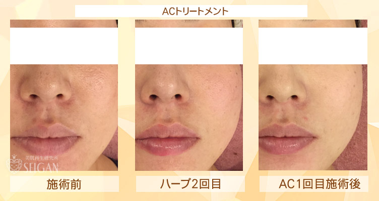 初めてリアボーテ ハーブトリートメント・ACトリートメントを受けた効果がすごい!ビフォーアフター写真一気に公開|東京 港区 外苑前駅から徒歩2分 「エステ以上、美容外科未満」のメディカル系エステなら 肌質改善のための 本格スキンケアエステサロン からだのことならへ|FCR・リアボーテハーブ・ACトリートメント・クレアスキン・グランスキン・リアムール基礎化粧品の正規取扱い店です。毛穴・ニキビ・ニキビ跡・クレーター・色素沈着・シワ・シミ・たるみのお悩みに肌質改善を