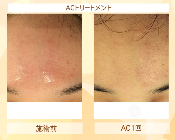 初めてリアボーテ ハーブトリートメント・ACトリートメントを受けた効果がすごい!ビフォーアフター写真一気に公開|東京 港区 外苑前駅から徒歩2分 「エステ以上、美容外科未満」のメディカル系エステなら 肌質改善のための 本格スキンケアエステサロン からだのことならへ|FCR・リアボーテハーブ・ACトリートメント・クレアスキン・グランスキン・リアムール基礎化粧品の正規取扱い店です。毛穴・ニキビ・ニキビ跡・クレーター・色素沈着・シワ・シミ・たるみのお悩みに肌質改善を