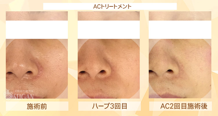 初めてリアボーテ ハーブトリートメント・ACトリートメントを受けた効果がすごい!ビフォーアフター写真一気に公開|東京 港区 外苑前駅から徒歩2分 「エステ以上、美容外科未満」のメディカル系エステなら 肌質改善のための 本格スキンケアエステサロン からだのことならへ|FCR・リアボーテハーブ・ACトリートメント・クレアスキン・グランスキン・リアムール基礎化粧品の正規取扱い店です。毛穴・ニキビ・ニキビ跡・クレーター・色素沈着・シワ・シミ・たるみのお悩みに肌質改善を