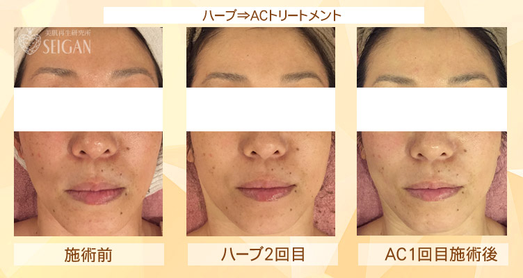 初めてリアボーテ ハーブトリートメント・ACトリートメントを受けた効果がすごい!ビフォーアフター写真一気に公開|東京 港区 外苑前駅から徒歩2分 「エステ以上、美容外科未満」のメディカル系エステなら 肌質改善のための 本格スキンケアエステサロン からだのことならへ|FCR・リアボーテハーブ・ACトリートメント・クレアスキン・グランスキン・リアムール基礎化粧品の正規取扱い店です。毛穴・ニキビ・ニキビ跡・クレーター・色素沈着・シワ・シミ・たるみのお悩みに肌質改善を