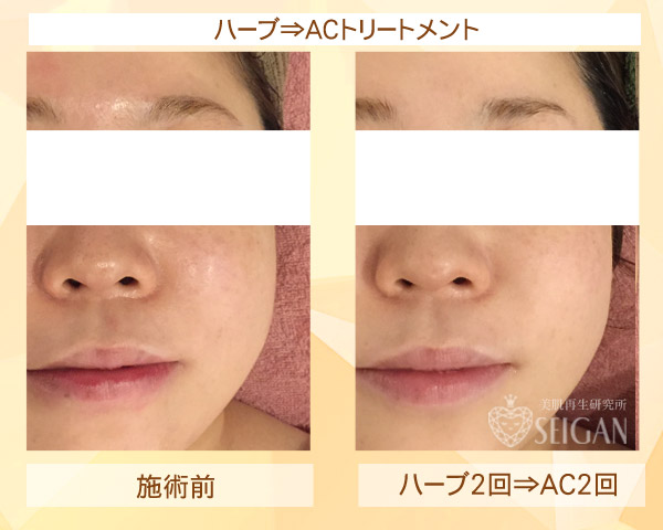 初めてリアボーテ ハーブトリートメント・ACトリートメントを受けた効果がすごい!ビフォーアフター写真一気に公開|東京 港区 外苑前駅から徒歩2分 「エステ以上、美容外科未満」のメディカル系エステなら 肌質改善のための 本格スキンケアエステサロン からだのことならへ|FCR・リアボーテハーブ・ACトリートメント・クレアスキン・グランスキン・リアムール基礎化粧品の正規取扱い店です。毛穴・ニキビ・ニキビ跡・クレーター・色素沈着・シワ・シミ・たるみのお悩みに肌質改善を