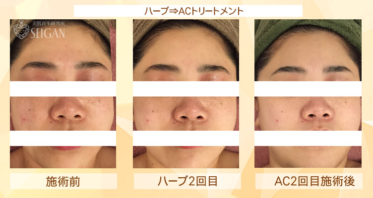 初めてリアボーテ ハーブトリートメント・ACトリートメントを受けた効果がすごい!ビフォーアフター写真一気に公開|東京 港区 外苑前駅から徒歩2分 「エステ以上、美容外科未満」のメディカル系エステなら 肌質改善のための 本格スキンケアエステサロン からだのことならへ|FCR・リアボーテハーブ・ACトリートメント・クレアスキン・グランスキン・リアムール基礎化粧品の正規取扱い店です。毛穴・ニキビ・ニキビ跡・クレーター・色素沈着・シワ・シミ・たるみのお悩みに肌質改善を