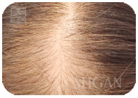 お試し幹細胞頭皮トリートメント｜【東京 港区 北青山】「からだのことなら」は、肌・髪・体・心の悩み改善に「丁寧に寄り添う」メディカル系ケア施術院です。薄毛・抜け毛・フケ・弱毛・頭皮のトラブル・白髪などでお悩みなら1度ご来院下さい。ACトリートメントとリアムール商品を使ったヘッドマッサージで頭皮ケアを行います。