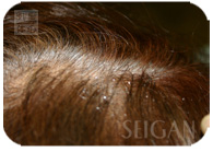 お試し幹細胞頭皮トリートメント｜【東京 港区 北青山】「からだのことなら」は、肌・髪・体・心の悩み改善に「丁寧に寄り添う」メディカル系ケア施術院です。薄毛・抜け毛・フケ・弱毛・頭皮のトラブル・白髪などでお悩みなら1度ご来院下さい。ACトリートメントとリアムール商品を使ったヘッドマッサージで頭皮ケアを行います。