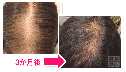 お試し幹細胞頭皮トリートメント｜【東京 港区 北青山】「からだのことなら」は、肌・髪・体・心の悩み改善に「丁寧に寄り添う」メディカル系ケア施術院です。薄毛・抜け毛・フケ・弱毛・頭皮のトラブル・白髪などでお悩みなら1度ご来院下さい。ACトリートメントとリアムール商品を使ったヘッドマッサージで頭皮ケアを行います。