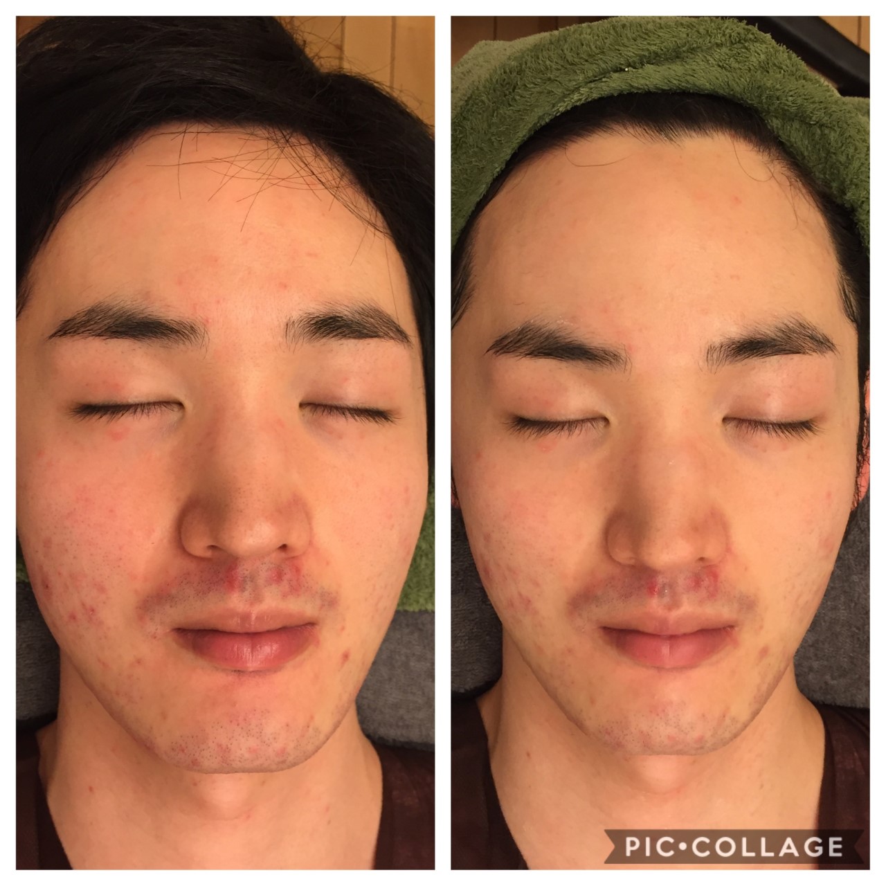 本気のメンズ美容フェイシャルサロンをお探しなら、東京 からだのことならへ｜男性の乾燥肌・ニキビ肌・カミソリ負け・テカリ肌・ザラザラ肌・薄毛の悩みの改善に「ヒト幹細胞と植物幹細胞による」メディカル系フェイシャルエステケア