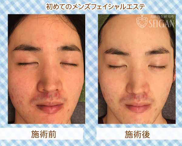 本気のメンズ美容フェイシャルサロンをお探しなら、東京 からだのことならへ｜男性の乾燥肌・ニキビ肌・カミソリ負け・テカリ肌・ザラザラ肌・薄毛の悩みの改善に「ヒト幹細胞と植物幹細胞による」メディカル系フェイシャルエステケア