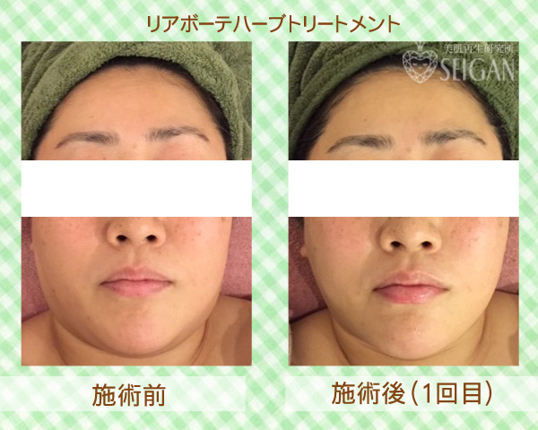 リアリアボーテハーブトリートメントビフォーアフター写真公開【東京 港区 北青山】「からだのことなら - 併設サロン ビューティースキンラボ AnnaCarna」は、肌・髪・体・心の悩みの改善に「丁寧に寄り添う」メディカル系ケア専門院です。毛穴/乾燥/脂性肌/化粧崩れ/赤ら顔/ニキビ/ニキビ跡/肌荒れ/アレルギーなどの「肌質改善」や、シミ/シワ/クマ/くすみ/たるみなどの「加齢肌」や、「小顔対策」でお悩みなら1度ご来院下さい。本格的なヒト由来幹細胞と植物幹細胞によるフェイシャルスキンケアエステで短期集中改善を目指します。リアボーテクレアスキン・グランスキン化粧品正規販売代理店。リアボーテ ハーブトリートメントとACトリートメントフェイシャルエステ正規取扱い店。完全予約制。個室完備。勧誘なし。クレジットカード可。実店舗あり。化粧品通販ショップ運営。