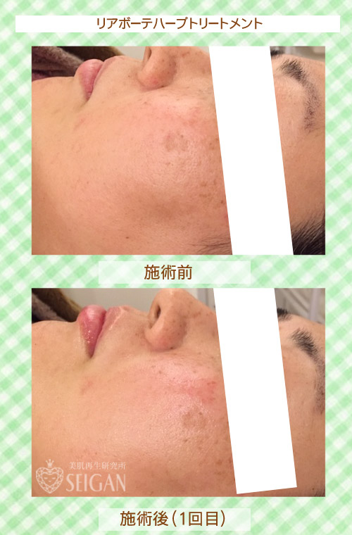 リアリアボーテハーブトリートメントビフォーアフター写真公開【東京 港区 北青山】「からだのことなら - 併設サロン ビューティースキンラボ AnnaCarna」は、肌・髪・体・心の悩みの改善に「丁寧に寄り添う」メディカル系ケア専門院です。毛穴/乾燥/脂性肌/化粧崩れ/赤ら顔/ニキビ/ニキビ跡/肌荒れ/アレルギーなどの「肌質改善」や、シミ/シワ/クマ/くすみ/たるみなどの「加齢肌」や、「小顔対策」でお悩みなら1度ご来院下さい。本格的なヒト由来幹細胞と植物幹細胞によるフェイシャルスキンケアエステで短期集中改善を目指します。リアボーテクレアスキン・グランスキン化粧品正規販売代理店。リアボーテ ハーブトリートメントとACトリートメントフェイシャルエステ正規取扱い店。完全予約制。個室完備。勧誘なし。クレジットカード可。実店舗あり。化粧品通販ショップ運営。