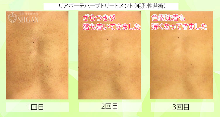 リアリアボーテハーブトリートメント毛孔性苔癬ビフォーアフター写真公開【東京 港区 北青山】「からだのことなら - 併設サロン ビューティースキンラボ AnnaCarna」は、肌・髪・体・心の悩みの改善に「丁寧に寄り添う」メディカル系ケア専門院です。毛穴/乾燥/脂性肌/化粧崩れ/赤ら顔/ニキビ/ニキビ跡/肌荒れ/アレルギーなどの「肌質改善」や、シミ/シワ/クマ/くすみ/たるみなどの「加齢肌」や、「小顔対策」でお悩みなら1度ご来院下さい。本格的なヒト由来幹細胞と植物幹細胞によるフェイシャルスキンケアエステで短期集中改善を目指します。リアボーテクレアスキン・グランスキン化粧品正規販売代理店。リアボーテ ハーブトリートメントとACトリートメントフェイシャルエステ正規取扱い店。完全予約制。個室完備。勧誘なし。クレジットカード可。実店舗あり。化粧品通販ショップ運営。