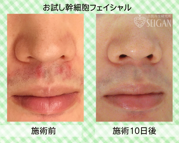 リアボーテお試し幹細胞フェイシャルトリートメントビフォーアフター写真公開【東京 港区 北青山】「からだのことなら - 併設サロン ビューティースキンラボ AnnaCarna」は、肌・髪・体・心の悩みの改善に「丁寧に寄り添う」メディカル系ケア専門院です。毛穴/乾燥/脂性肌/化粧崩れ/赤ら顔/ニキビ/ニキビ跡/肌荒れ/アレルギーなどの「肌質改善」や、シミ/シワ/クマ/くすみ/たるみなどの「加齢肌」や、「小顔対策」でお悩みなら1度ご来院下さい。本格的なヒト由来幹細胞と植物幹細胞によるフェイシャルスキンケアエステで短期集中改善を目指します。リアボーテクレアスキン・グランスキン化粧品正規販売代理店。リアボーテ ハーブトリートメントとACトリートメントフェイシャルエステ正規取扱い店。完全予約制。個室完備。勧誘なし。クレジットカード可。実店舗あり。化粧品通販ショップ運営。