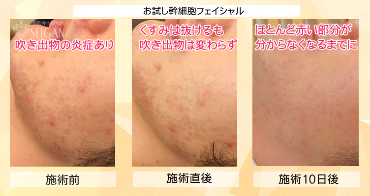 リアボーテお試し幹細胞フェイシャルトリートメントビフォーアフター写真公開【東京 港区 北青山】「からだのことなら - 併設サロン ビューティースキンラボ AnnaCarna」は、肌・髪・体・心の悩みの改善に「丁寧に寄り添う」メディカル系ケア専門院です。毛穴/乾燥/脂性肌/化粧崩れ/赤ら顔/ニキビ/ニキビ跡/肌荒れ/アレルギーなどの「肌質改善」や、シミ/シワ/クマ/くすみ/たるみなどの「加齢肌」や、「小顔対策」でお悩みなら1度ご来院下さい。本格的なヒト由来幹細胞と植物幹細胞によるフェイシャルスキンケアエステで短期集中改善を目指します。リアボーテクレアスキン・グランスキン化粧品正規販売代理店。リアボーテ ハーブトリートメントとACトリートメントフェイシャルエステ正規取扱い店。完全予約制。個室完備。勧誘なし。クレジットカード可。実店舗あり。化粧品通販ショップ運営。