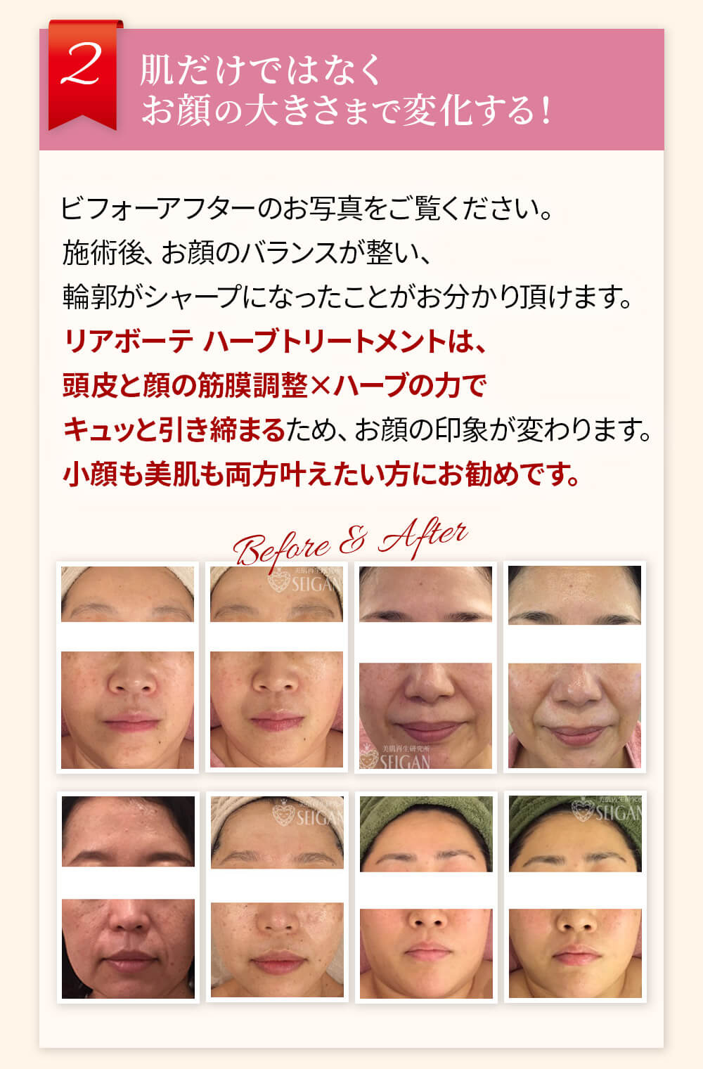 初めての リアボーテ ハーブトリートメントなら 東京 からだのことなら｜口コミ 効果 ダウンタイムなし 剥離なし 値段 など徹底解説　【スキンケア専門サロン 美肌再生研究所 SEIGAN】