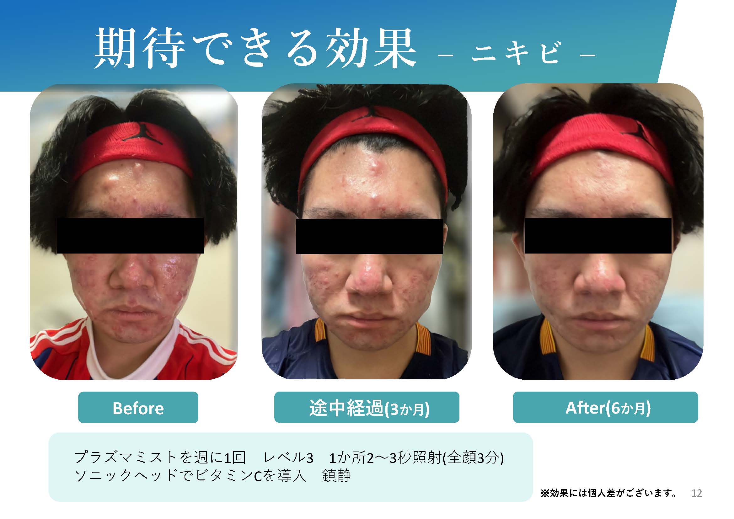 iPS BioCellCare AnnaCarna アンナカルナ【シミケア専科 プラズマ O:Celloオセロ 併設】 ≪高濃度ヒト幹細胞培養液/iPSフェイシャルエステサロン≫ 肌質改善☆年齢肌☆小顔矯正☆シミ取り専門◆シミ取り放題×プラズマミストシャワーコースが人気◆芸能人ご用達コスメ「リアボーテ」正規取扱店◆リアボーテクレアスキン化粧品・リアボーテグランスキン化粧品・リアボーテシェリースキン化粧品・エキスパートローション・リアムール・健美草｜口コミ・効果・使い方・ビフォーアフター・動画・写真・方法・通販・ネット販売・対象外商品★港区 南青山 銀座線 外苑前駅★青山一丁目駅★個室完備