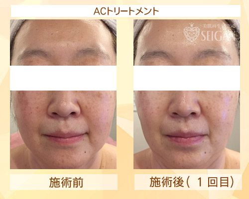 ビフォーアフター｜≪高濃度ヒト幹細胞培養液/プラズマフェイシャルサロン≫ AnnaCarna アンナカルナ 東京【シミケア専科 プラズマ O:Celloオセロ 東京 併設】肌質改善☆年齢肌☆小顔矯正☆シミ取りレーザーに変わるシミケア専門◆プラズマシャワー・プラズマミスト・プラズマニードル◆SNSで人気の芸能人のプライベートコスメ「リアボーテ化粧品」正規取扱店・クレアスキン・グランスキン・シェリースキン・エキスパートローション・リアムール・エキスパートスタイル・健美草◆購入方法・口コミ・効果・使い方・ビフォーアフター・動画・写真・通販・ネット販売対象外商品◆港区 南青山 銀座線 外苑前駅・半蔵門線・田園都市線・青山一丁目駅◆個室完備・医療提携サロン・メディカルエステ