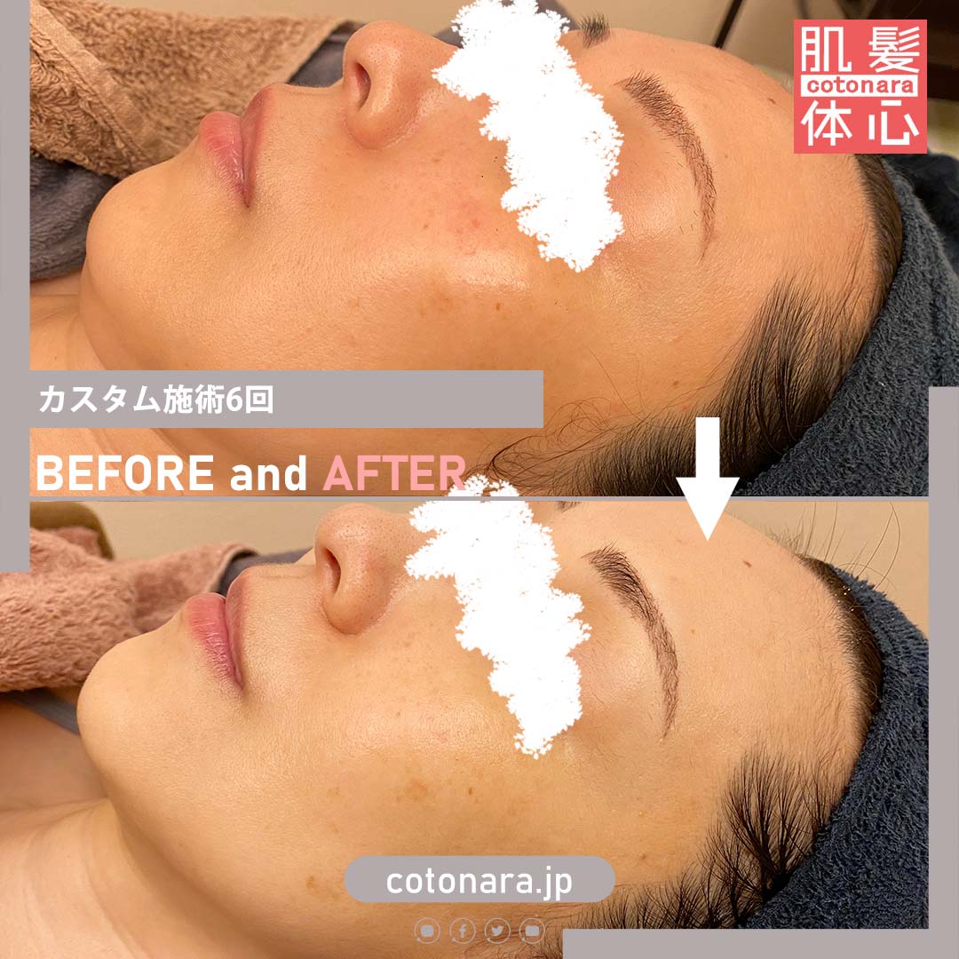 フェイスラインビフォーアフター写真・口コミ|AnnaCarna アンナカルナ/優秀店/シミケア専門/プラズマフェイシャル/O:Celloオセロ/高濃度ヒト幹細胞/iPS細胞エステ/リアボーテ正規取扱店/リアボーテクレアスキン/リアボーテグランスキン/リアボーテシェリースキン/リアムールエキスパートローション/健美草/シミ取り放題/プラズマミストシャワー/肌質改善/小顔矯正/年齢肌ケア/毛穴改善/たるみケア/再生美容/ビフォーアフター/効果実感/使い方/口コミ/動画紹介/写真/方法/通販/ネット販売/オンラインカウンセリング/通販不可製品/正規販売店/芸能人愛用コスメ/幹細胞スキンケア/港区南青山/外苑前駅/青山一丁目駅/エステ個室完備