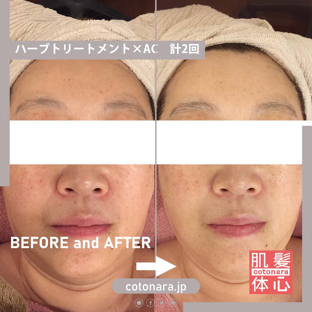 シミくすみビフォーアフター写真・口コミ|AnnaCarna アンナカルナ/優秀店/シミケア専門/プラズマフェイシャル/O:Celloオセロ/高濃度ヒト幹細胞/iPS細胞エステ/リアボーテ正規取扱店/リアボーテクレアスキン/リアボーテグランスキン/リアボーテシェリースキン/リアムールエキスパートローション/健美草/シミ取り放題/プラズマミストシャワー/肌質改善/小顔矯正/年齢肌ケア/毛穴改善/たるみケア/再生美容/ビフォーアフター/効果実感/使い方/口コミ/動画紹介/写真/方法/通販/ネット販売/オンラインカウンセリング/通販不可製品/正規販売店/芸能人愛用コスメ/幹細胞スキンケア/港区南青山/外苑前駅/青山一丁目駅/エステ個室完備