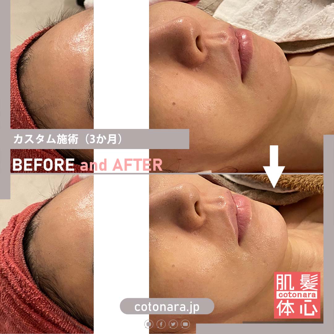 ハリ艶・ビフォーアフター写真・口コミ|AnnaCarna アンナカルナ/優秀店/シミケア専門/プラズマフェイシャル/O:Celloオセロ/高濃度ヒト幹細胞/iPS細胞エステ/リアボーテ正規取扱店/リアボーテクレアスキン/リアボーテグランスキン/リアボーテシェリースキン/リアムールエキスパートローション/健美草/シミ取り放題/プラズマミストシャワー/肌質改善/小顔矯正/年齢肌ケア/毛穴改善/たるみケア/再生美容/ビフォーアフター/効果実感/使い方/口コミ/動画紹介/写真/方法/通販/ネット販売/オンラインカウンセリング/通販不可製品/正規販売店/芸能人愛用コスメ/幹細胞スキンケア/港区南青山/外苑前駅/青山一丁目駅/エステ個室完備