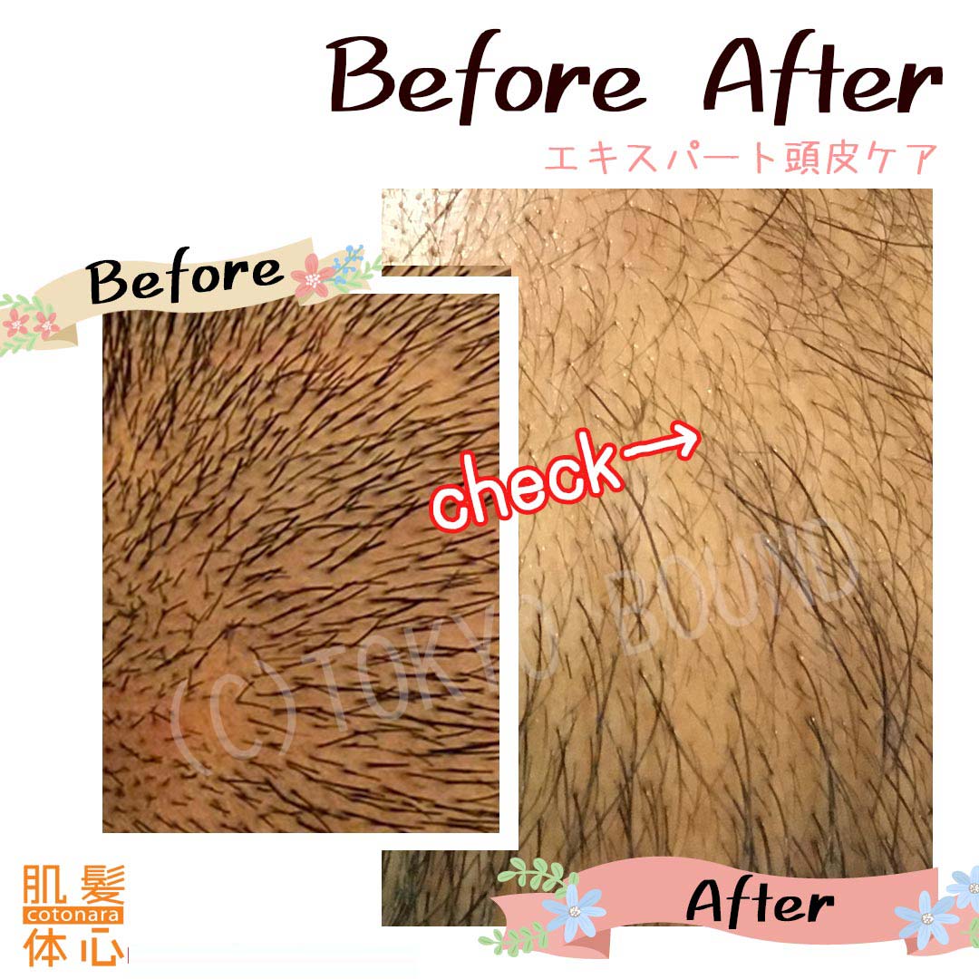 育毛・養毛・薄毛ビフォーアフター写真・口コミ|AnnaCarna アンナカルナ/優秀店/シミケア専門/プラズマフェイシャル/O:Celloオセロ/高濃度ヒト幹細胞/iPS細胞エステ/リアボーテ正規取扱店/リアボーテクレアスキン/リアボーテグランスキン/リアボーテシェリースキン/リアムールエキスパートローション/健美草/シミ取り放題/プラズマミストシャワー/肌質改善/小顔矯正/年齢肌ケア/毛穴改善/たるみケア/再生美容/ビフォーアフター/効果実感/使い方/口コミ/動画紹介/写真/方法/通販/ネット販売/オンラインカウンセリング/通販不可製品/正規販売店/芸能人愛用コスメ/幹細胞スキンケア/港区南青山/外苑前駅/青山一丁目駅/エステ個室完備