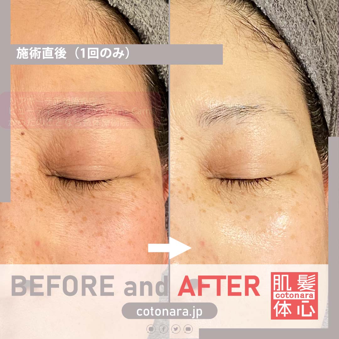 ビフォーアフタープラズマフェイシャル｜AnnaCarna アンナカルナ/優秀店/シミケア専門／プラズマフェイシャル／O:Celloオセロ導入店／高濃度ヒト幹細胞／iPS細胞エステ／リアボーテ正規取扱店／リアボーテクレアスキン／リアボーテグランスキン／リアボーテシェリースキン／リアムールエキスパートローション／健美草／シミ取り放題／プラズマミストシャワー／肌質改善／小顔矯正／年齢肌ケア／毛穴改善／たるみケア／再生美容／ビフォーアフター／効果実感／使い方／口コミ／動画紹介／写真／方法／通販／ネット販売／オンラインカウンセリング／通販不可製品／正規販売店／芸能人愛用コスメ／幹細胞スキンケア／港区南青山／外苑前駅／青山一丁目駅／エステ個室完備