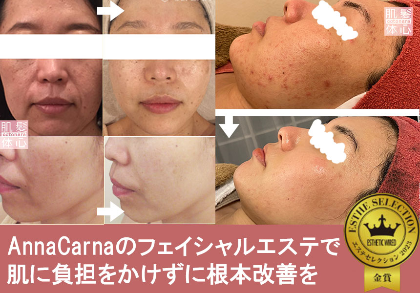 ビフォーアフタ｜AnnaCarna アンナカルナ/優秀店/シミケア専門／プラズマフェイシャル／O:Celloオセロ導入店／高濃度ヒト幹細胞／iPS細胞エステ／リアボーテ正規取扱店／リアボーテクレアスキン／リアボーテグランスキン／リアボーテシェリースキン／リアムールエキスパートローション／健美草／シミ取り放題／プラズマミストシャワー／肌質改善／小顔矯正／年齢肌ケア／毛穴改善／たるみケア／再生美容／ビフォーアフター／効果実感／使い方／口コミ／動画紹介／写真／方法／通販／ネット販売／オンラインカウンセリング／通販不可製品／正規販売店／芸能人愛用コスメ／幹細胞スキンケア／港区南青山／外苑前駅／青山一丁目駅／エステ個室完備