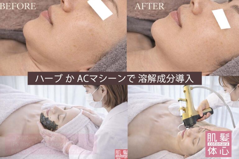 リアボーテ美容溶解トリートメント（エンマ）でいらない脂肪溶解 フェイスラインもマリオネットラインもほうれい線もたるみもスッキリ｜AnnaCarna アンナカルナ/優秀店/シミケア専門／プラズマフェイシャル／O:Celloオセロ導入店／高濃度ヒト幹細胞／iPS細胞エステ／リアボーテ正規取扱店／リアボーテクレアスキン／リアボーテグランスキン／リアボーテシェリースキン／リアムールエキスパートローション／健美草／シミ取り放題／プラズマミストシャワー／肌質改善／小顔矯正／年齢肌ケア／毛穴改善／たるみケア／再生美容／ビフォーアフター／効果実感／使い方／口コミ／動画紹介／写真／方法／通販／ネット販売／オンラインカウンセリング／通販不可製品／正規販売店／芸能人愛用コスメ／幹細胞スキンケア／港区南青山／外苑前駅／青山一丁目駅／エステ個室完備