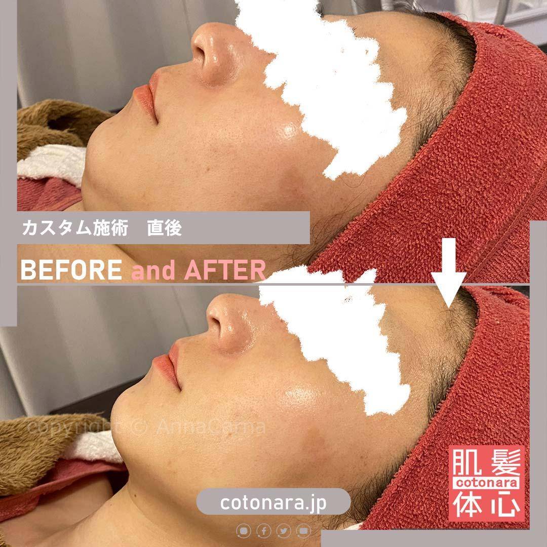 ビフォーアフター｜東京 港区北青山 外苑前駅 幹細胞フェイシャル美容専門店 からだのことなら【リアボーテ正規取扱販売店 ビューティースキンラボ AnnaCarna】｜クレアスキン化粧品・グランスキン化粧品・シェリースキン・エキスパートローション・アコライム・リアムールのご購入はこちらから｜口コミ・効果・使い方・通販ネットショップ