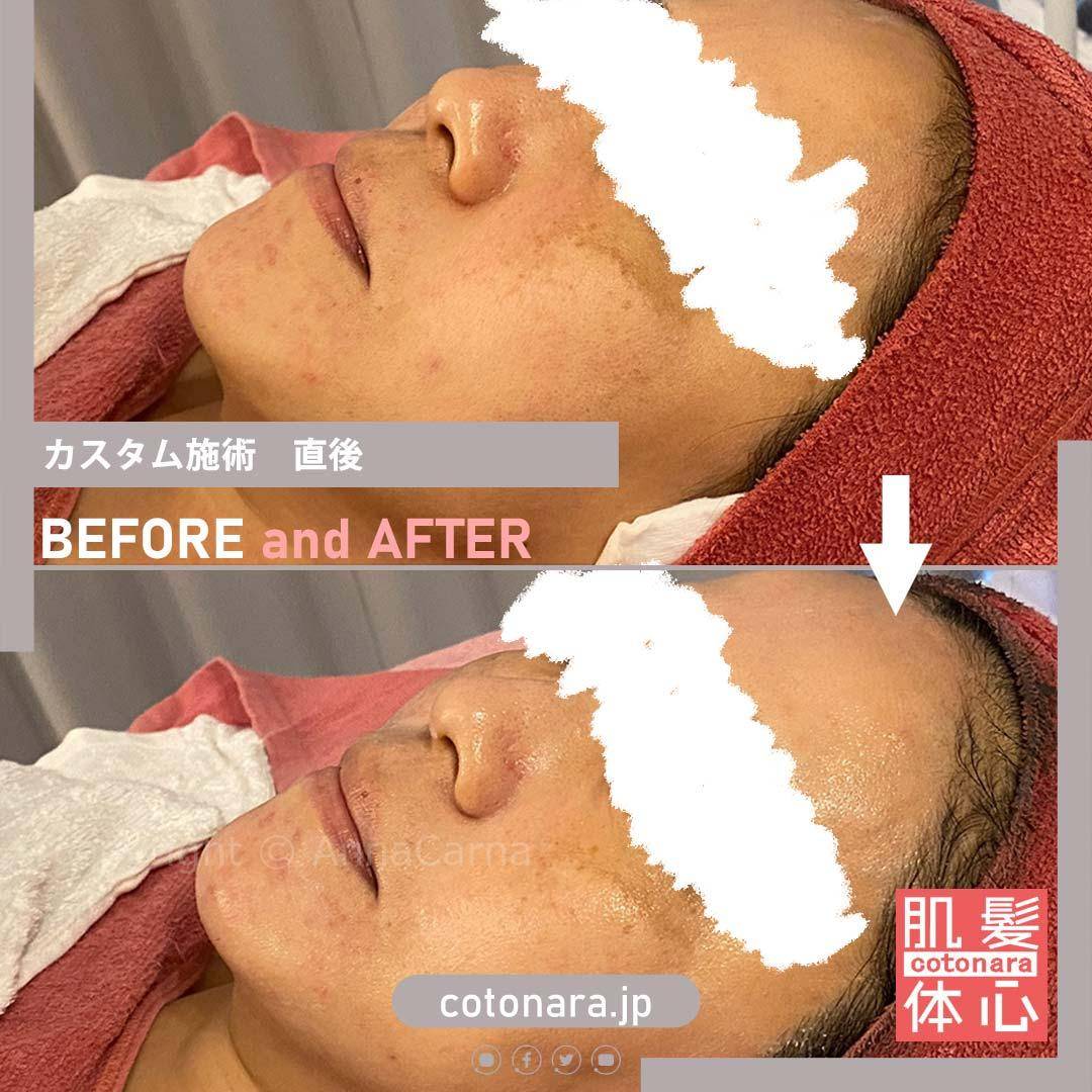 ビフォーアフター｜東京 港区北青山 外苑前駅 幹細胞フェイシャル美容専門店 からだのことなら【リアボーテ正規取扱販売店 ビューティースキンラボ AnnaCarna】｜クレアスキン化粧品・グランスキン化粧品・シェリースキン・エキスパートローション・アコライム・リアムールのご購入はこちらから｜口コミ・効果・使い方・通販ネットショップ