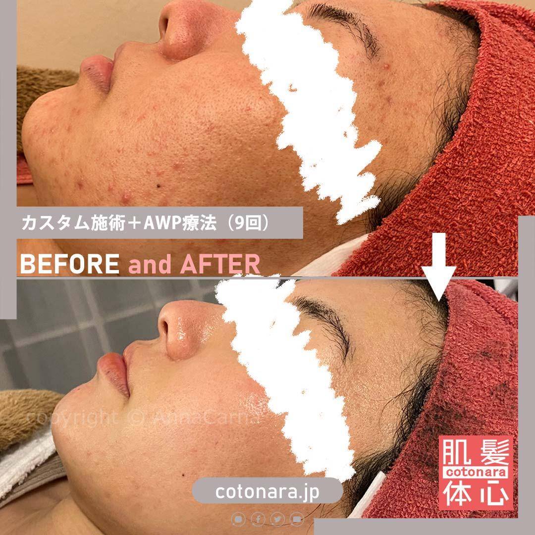 ビフォーアフター｜東京 港区北青山 外苑前駅 幹細胞フェイシャル美容専門店 からだのことなら【リアボーテ正規取扱販売店 ビューティースキンラボ AnnaCarna】｜クレアスキン化粧品・グランスキン化粧品・シェリースキン・エキスパートローション・アコライム・リアムールのご購入はこちらから｜口コミ・効果・使い方・通販ネットショップ