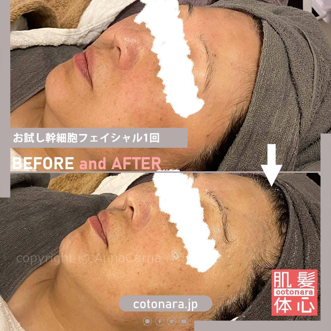 ビフォーアフター｜東京 港区北青山 外苑前駅 幹細胞フェイシャル美容専門店 からだのことなら【リアボーテ正規取扱販売店 ビューティースキンラボ AnnaCarna】｜クレアスキン化粧品・グランスキン化粧品・シェリースキン・エキスパートローション・アコライム・リアムールのご購入はこちらから｜口コミ・効果・使い方・通販ネットショップ