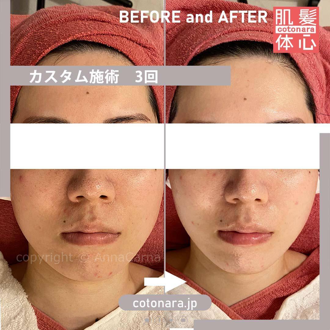 ビフォーアフター｜東京 港区北青山 外苑前駅 幹細胞フェイシャル美容専門店 からだのことなら【リアボーテ正規取扱販売店 ビューティースキンラボ AnnaCarna】｜クレアスキン化粧品・グランスキン化粧品・シェリースキン・エキスパートローション・アコライム・リアムールのご購入はこちらから｜口コミ・効果・使い方・通販ネットショップ