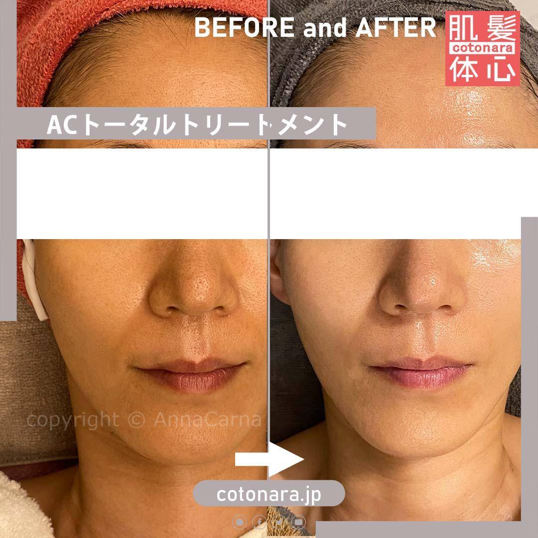 ビフォーアフター｜東京 港区北青山 外苑前駅 幹細胞フェイシャル美容専門店 からだのことなら【リアボーテ正規取扱販売店 ビューティースキンラボ AnnaCarna】｜クレアスキン化粧品・グランスキン化粧品・シェリースキン・エキスパートローション・アコライム・リアムールのご購入はこちらから｜口コミ・効果・使い方・通販ネットショップ