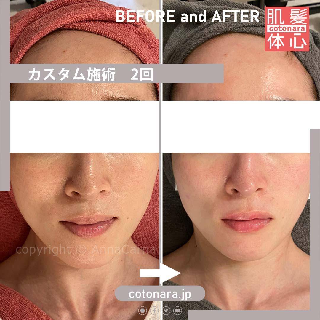 ビフォーアフター｜東京 港区北青山 外苑前駅 幹細胞フェイシャル美容専門店 からだのことなら【リアボーテ正規取扱販売店 ビューティースキンラボ AnnaCarna】｜クレアスキン化粧品・グランスキン化粧品・シェリースキン・エキスパートローション・アコライム・リアムールのご購入はこちらから｜口コミ・効果・使い方・通販ネットショップ