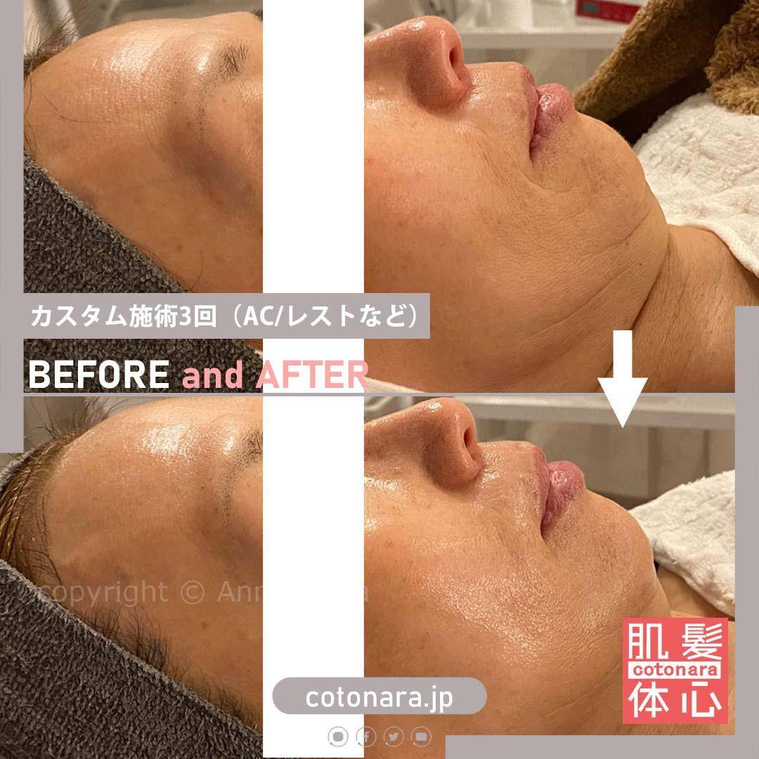 ビフォーアフター｜東京 港区北青山 外苑前駅 幹細胞フェイシャル美容専門店 からだのことなら【リアボーテ正規取扱販売店 ビューティースキンラボ AnnaCarna】｜クレアスキン化粧品・グランスキン化粧品・シェリースキン・エキスパートローション・アコライム・リアムールのご購入はこちらから｜口コミ・効果・使い方・通販ネットショップ