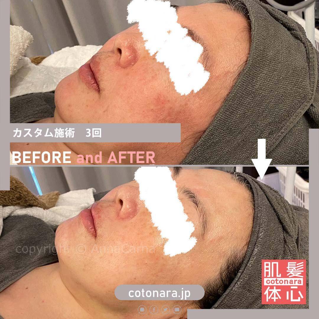 ビフォーアフター｜東京 港区北青山 外苑前駅 幹細胞フェイシャル美容専門店 からだのことなら【リアボーテ正規取扱販売店 ビューティースキンラボ AnnaCarna】｜クレアスキン化粧品・グランスキン化粧品・シェリースキン・エキスパートローション・アコライム・リアムールのご購入はこちらから｜口コミ・効果・使い方・通販ネットショップ