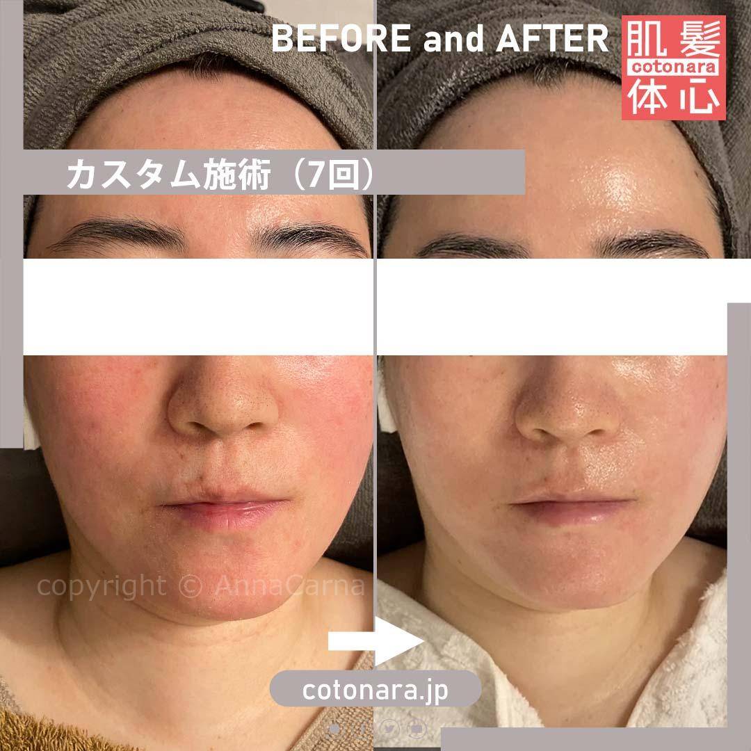 ビフォーアフター｜東京 港区北青山 外苑前駅 幹細胞フェイシャル美容専門店 からだのことなら【リアボーテ正規取扱販売店 ビューティースキンラボ AnnaCarna】｜クレアスキン化粧品・グランスキン化粧品・シェリースキン・エキスパートローション・アコライム・リアムールのご購入はこちらから｜口コミ・効果・使い方・通販ネットショップ